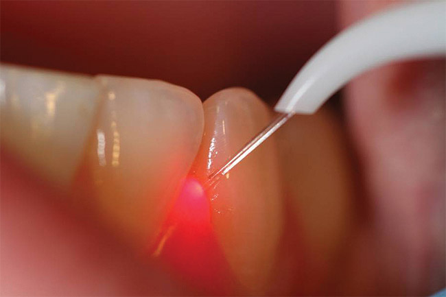 Πρωτοποριακή θεραπεία ουλίτιδας με laser > Dental Laser Clinic